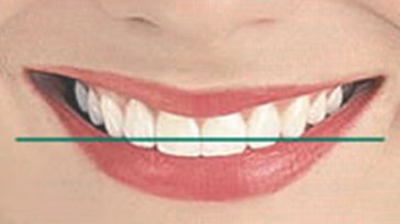 Smile Designing - Horizontal Line