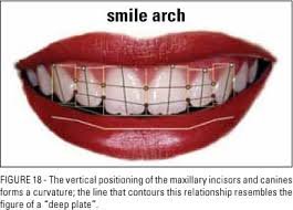 Smile Arch