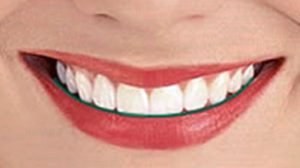 Smile Line 